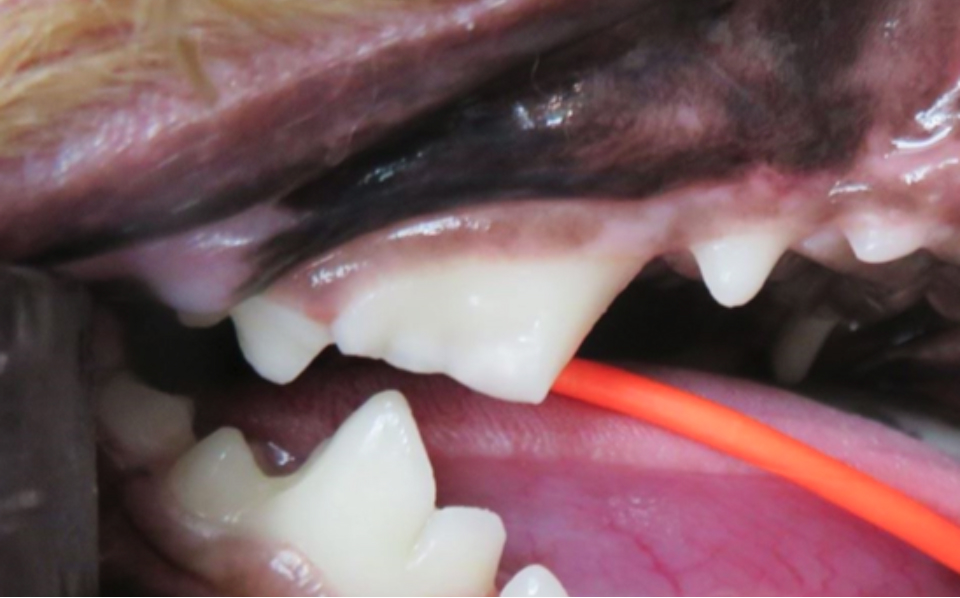歯冠破折の処置後写真