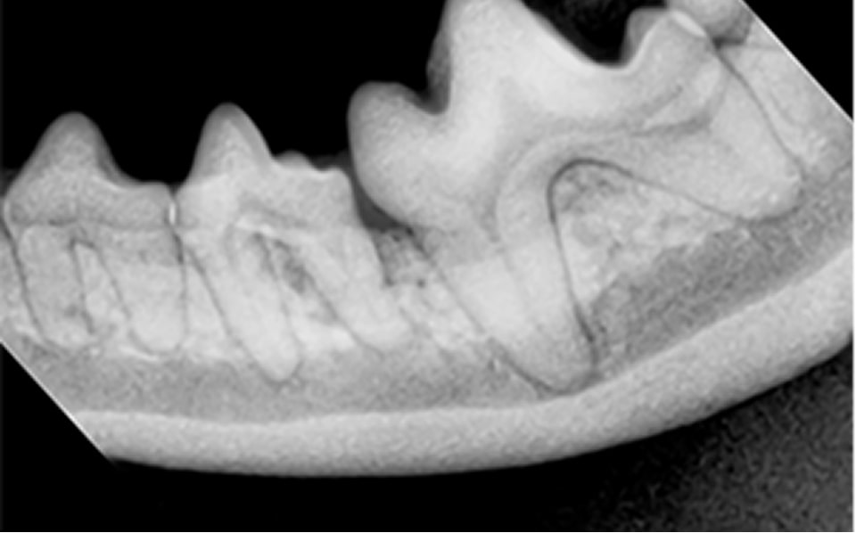 重度歯周病の処置後写真
