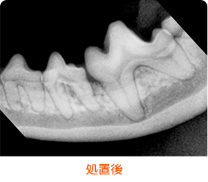 重度歯周病_処置後イメージ